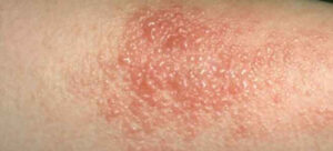 Dermatite sulla pelle umana