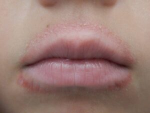 Dermatite periorale sulla bocca di un ragazzo