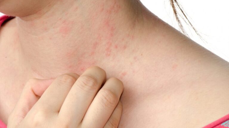 Ragazza si prude il collo per la dermatite