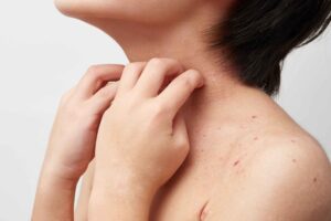 Donna si gratta il collo a causa della dermatite