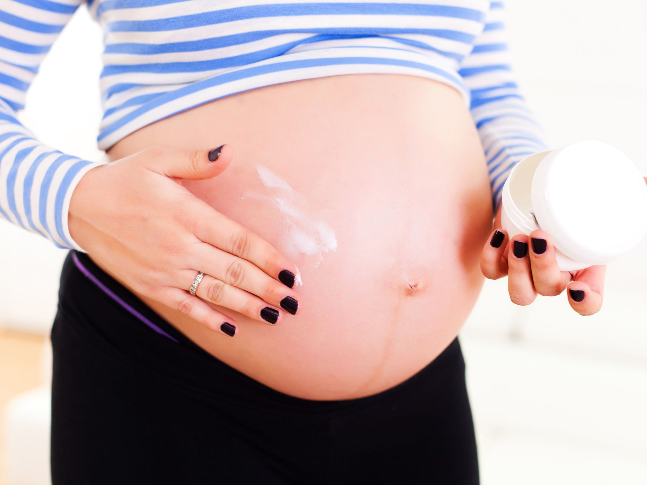 Smagliature in gravidanza: cause, rimedi e come prevenirle